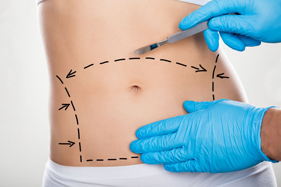 Abdominoplastik Recklinghausen